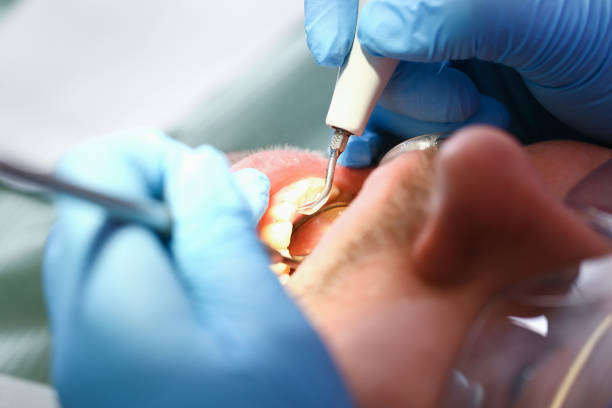 Best Urgent Care for Lost Fillings or Crowns in High Springs, FL