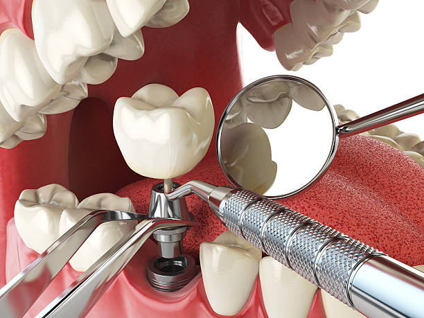 Best Emergency Dental Care for Broken or Chipped Teeth in High Springs, FL